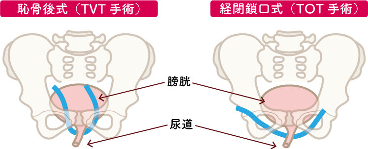 TVT手術、TOT手術