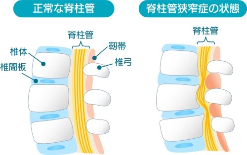 脊柱管狭窄症