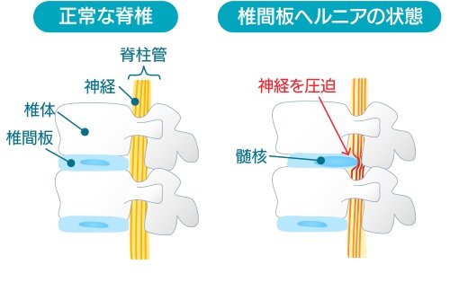 椎間板ヘルニア