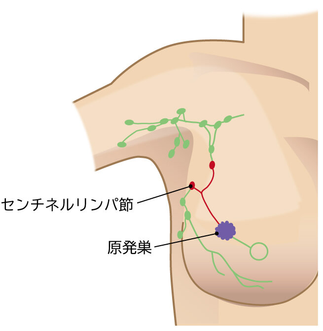 センチネルリンパ節検査