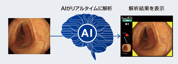 AI搭載、大腸内視鏡画像診断システム